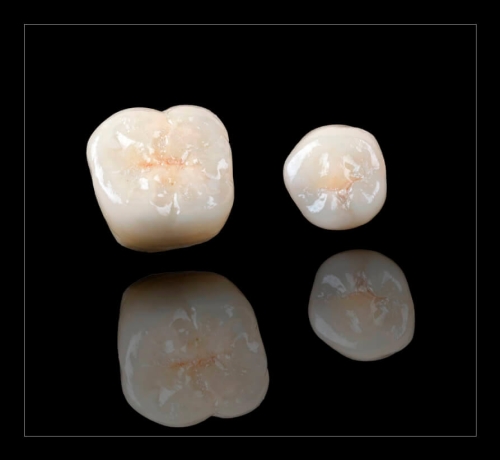 Зубные коронки и мостовидные протезы