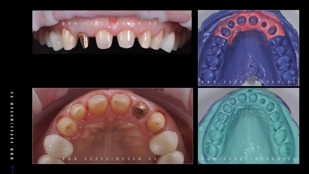 Протезирование передних зубов