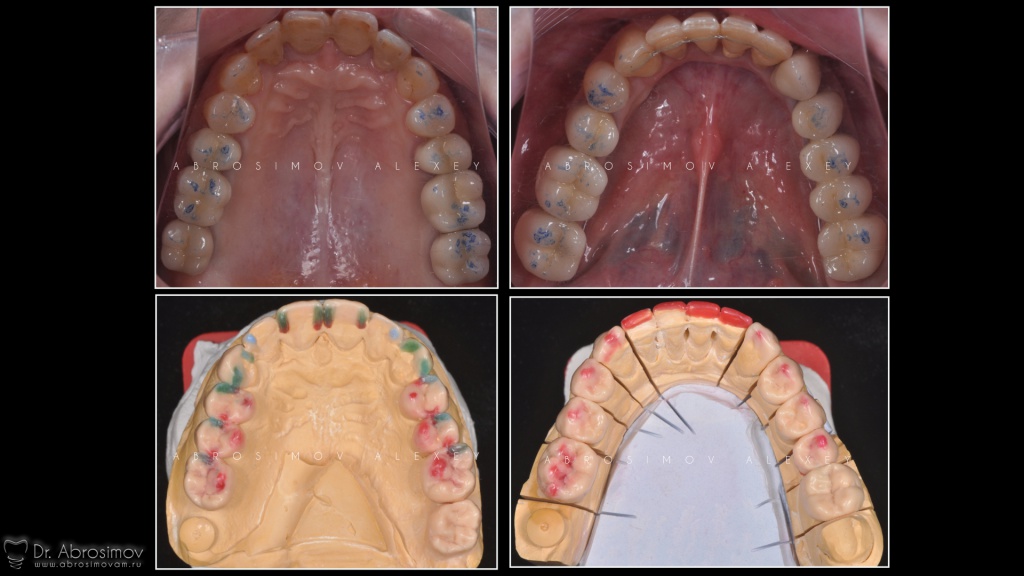 Полное протезирование зубов на имплантах