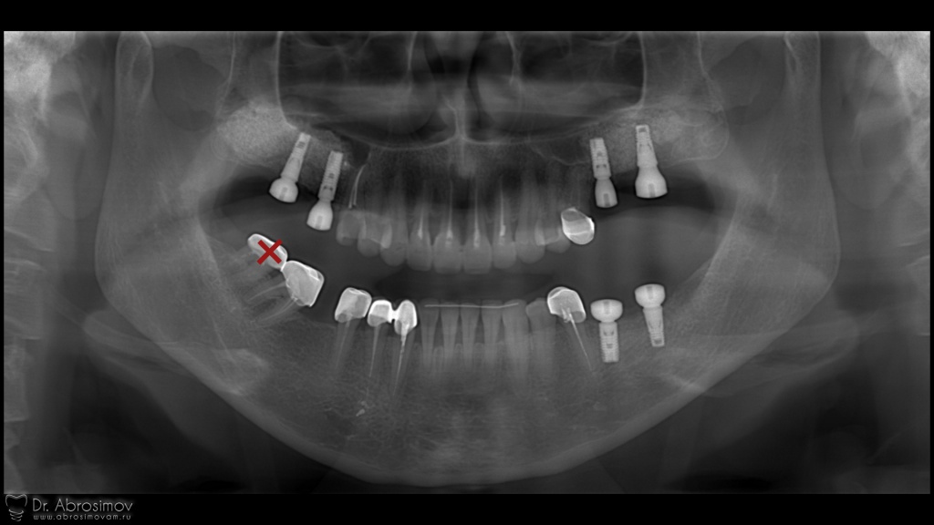 Удаление восьмого зуба