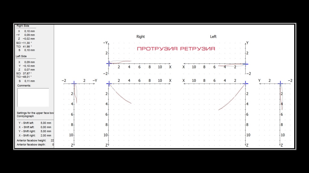 Кондилография Кондилография