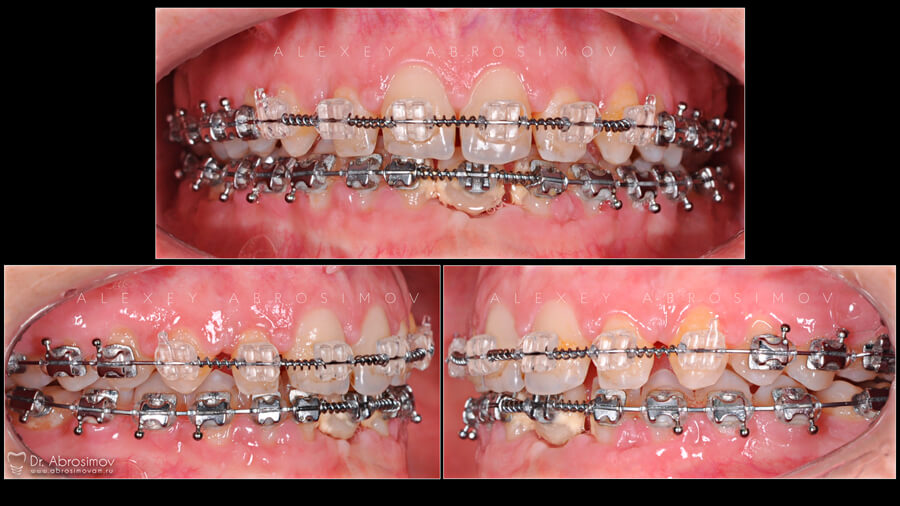 Исправление зубов брекетами