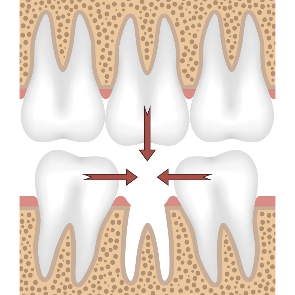 Смещение зубов. Кривые зубы: как исправить