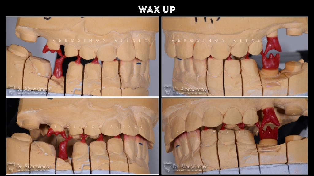 Wax up