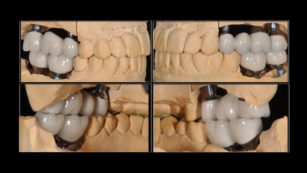Зубное протезирование на имплантах