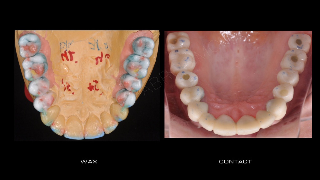 Wax up Wax up